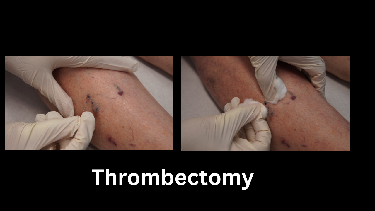 thrombectomy-after-sclerotherapy