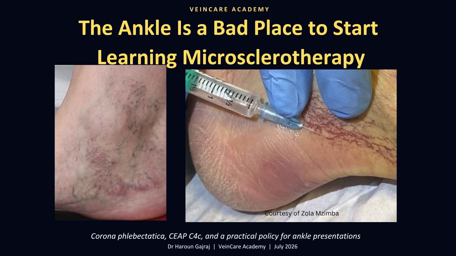 The ankle is a bad place to start learning Microsclerotherapy. 