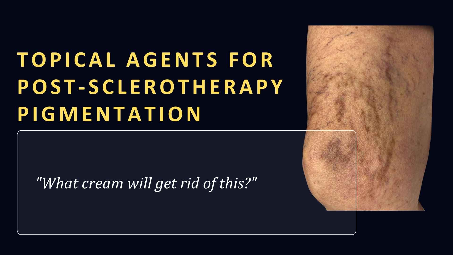 Featured header graphic titled "Topical Agents for Post-Sclerotherapy Pigmentation" with a patient quote box reading '"What cream will get rid of this?"'. The graphic features a clinical photograph of a leg showing post-sclerotherapy brown staining and hyperpigmentation following spider vein treatment. VeinCare Academy article header.