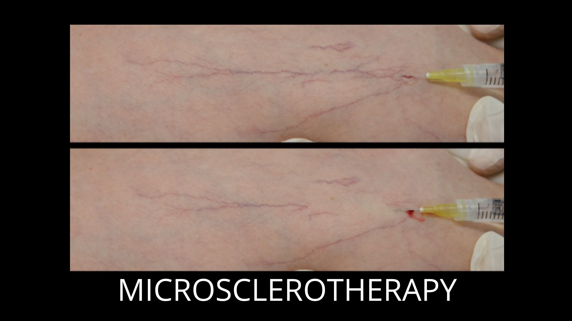who-can-inject-leg-spider-veins-by-microsclerotherapy