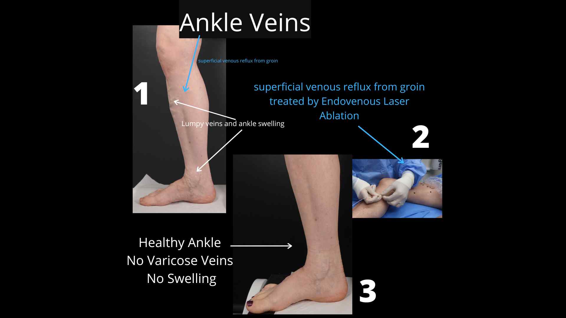 What-Causes-ankle-Veins