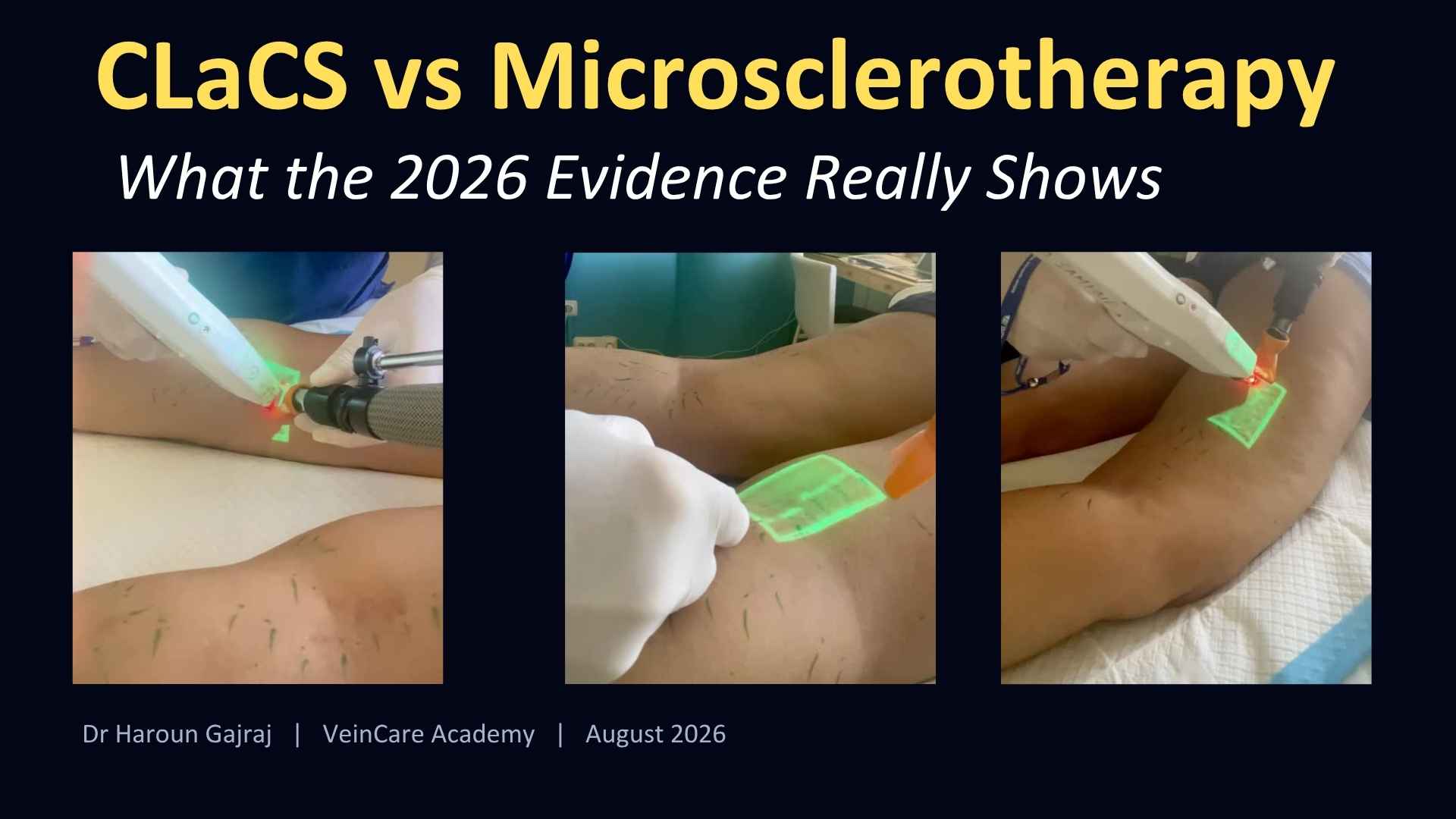 CLaCS vs Microsclerotherapy blog featured graphic showing three clinical views of cryo-laser and augmented reality vein visualization on a patient's leg, titled "What the 2026 Evidence Really Shows" by Dr Haroun Gajraj