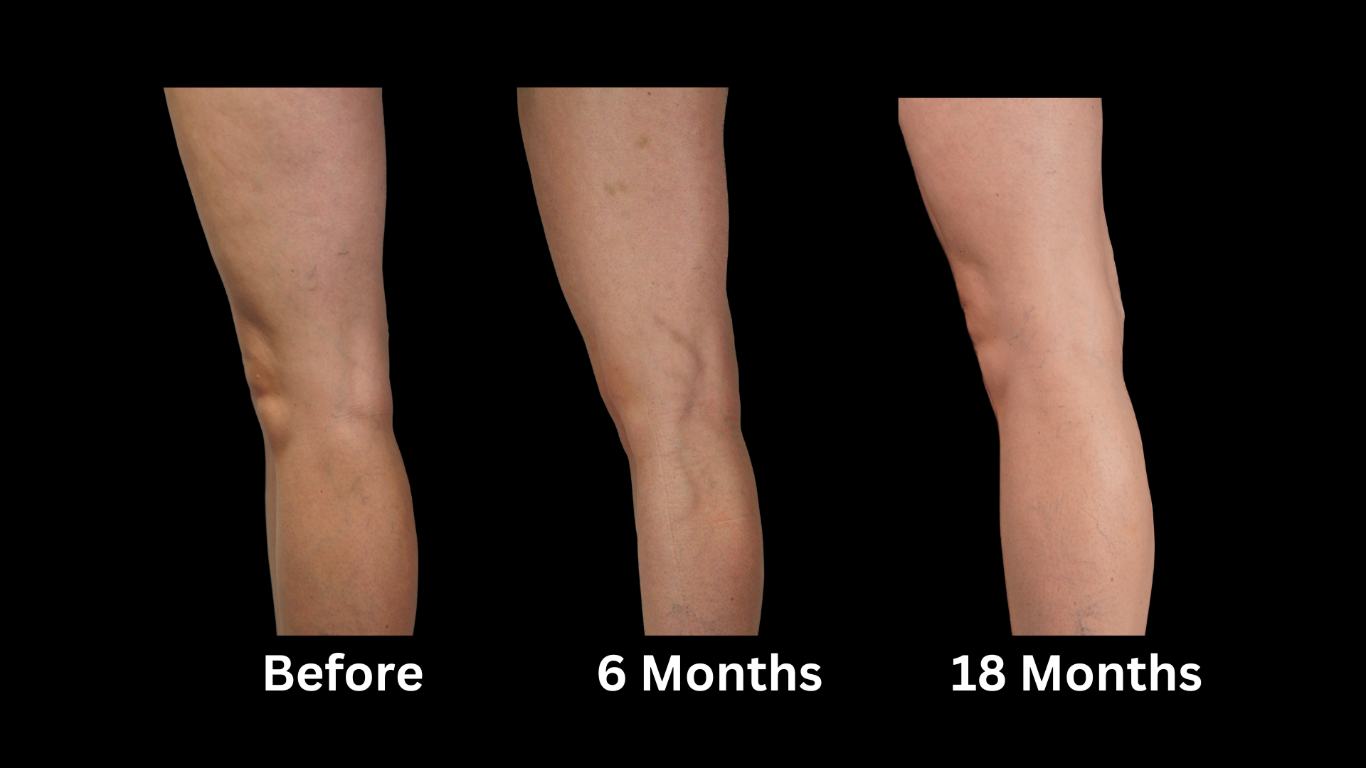 Brown-Marks-After-Sclerotherapy-photographs